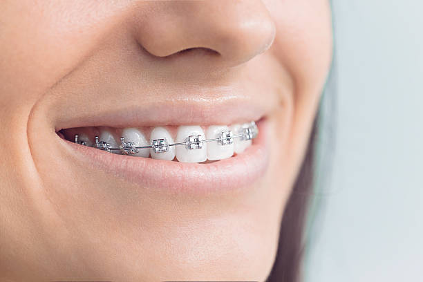 Dental Bonding in Baton Rouge, LA